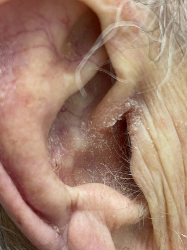 Ear care conditions & management The Nurse Clinic Bedford