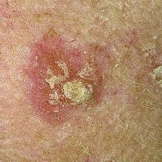 ACTINIC KERATOSIS