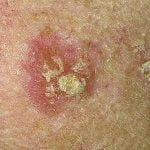 ACTINIC KERATOSIS