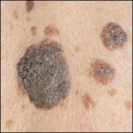 SEBORRHEIC KERATOSIS