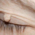 skin tag removal eyelid