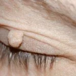 skin tag removal eyelid