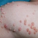 MOLLUSCUM CONTINGIOSUM