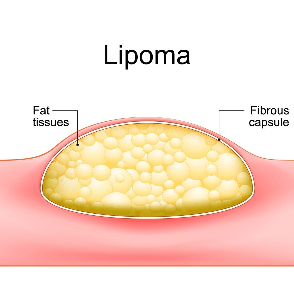 lipoma