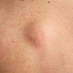 Lipoma
