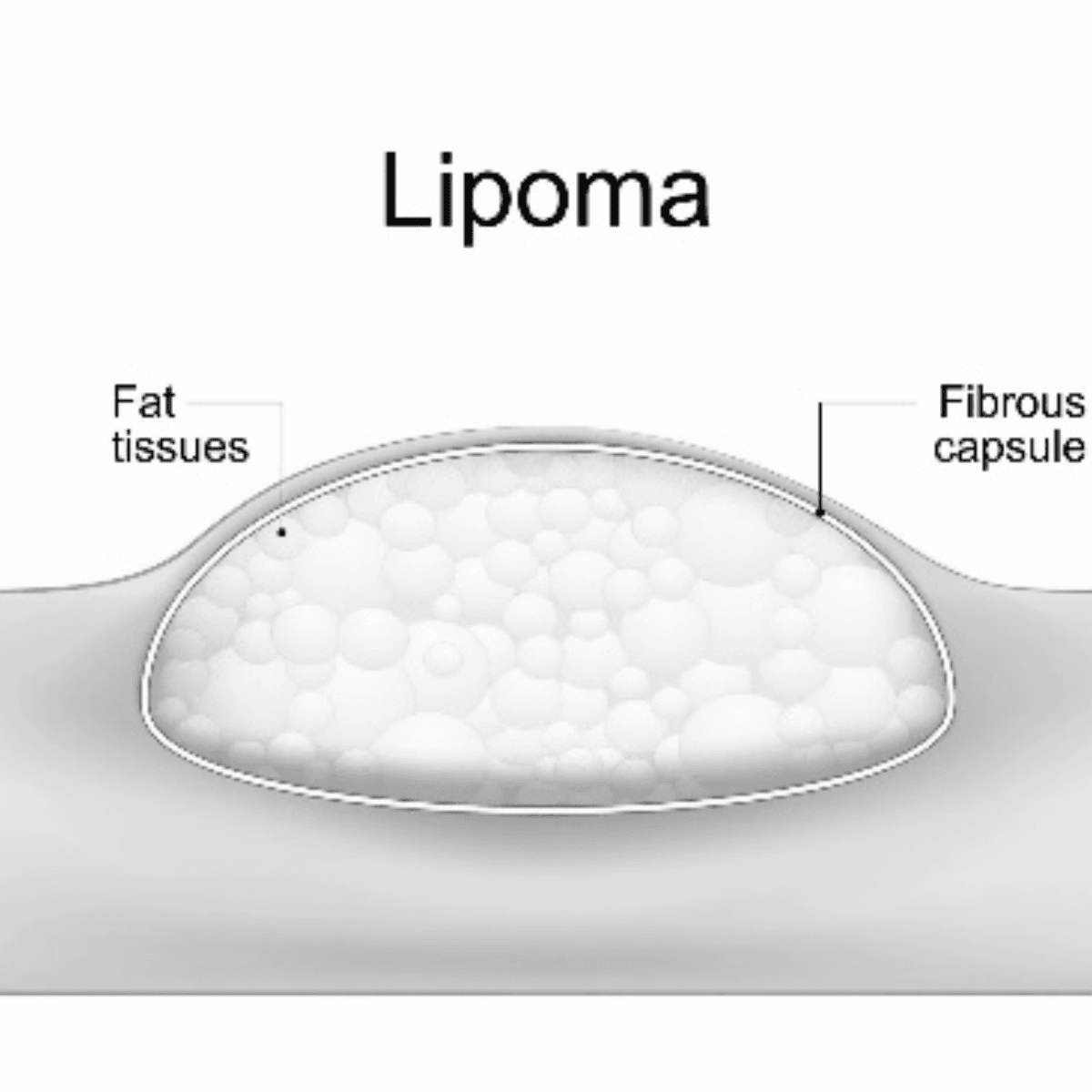 LIPOMA REMOVAL