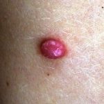 pyogenic granuloma