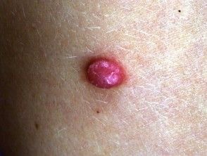 pyogenic granuloma