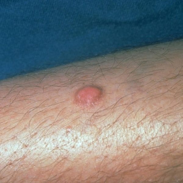 Dermatofibroma